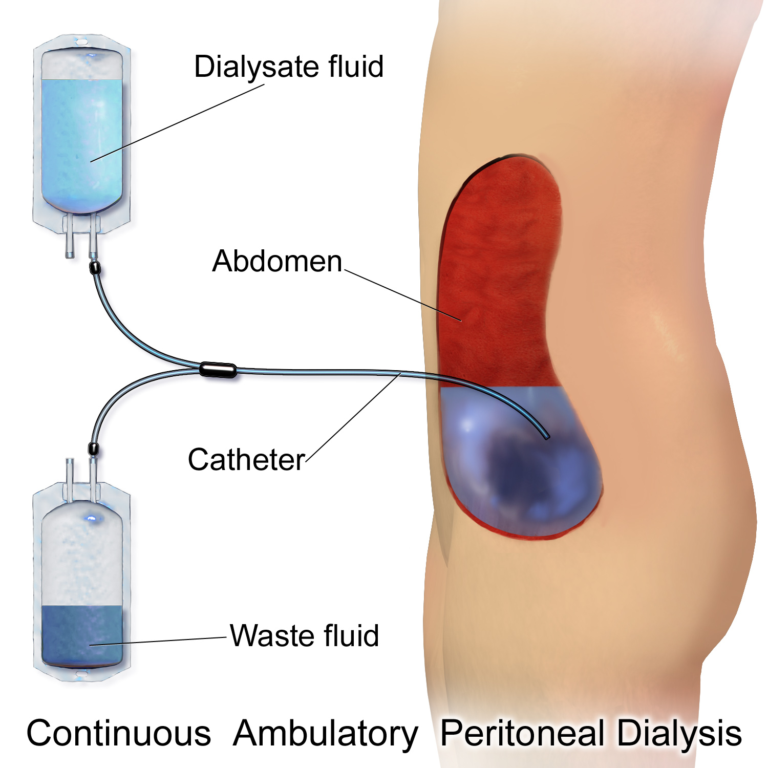 Continuous Ambulatory Peritoneal Dialysis