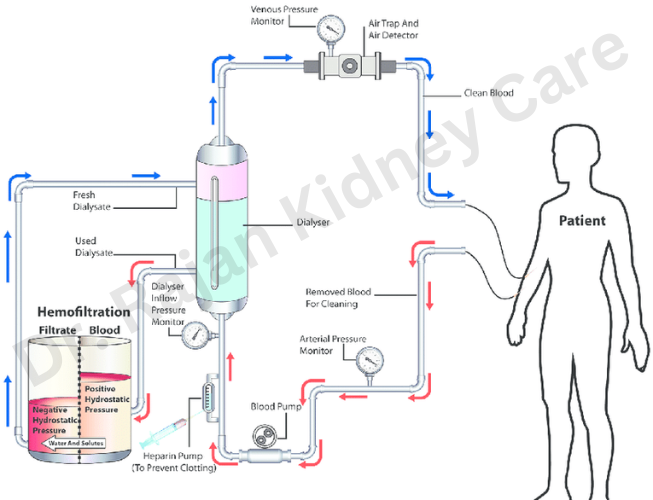 What is Hemofiltration