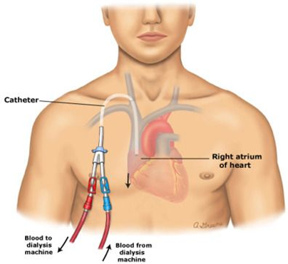 Vascular Access Work Including Permcath