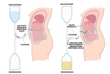 Continuous-ambulatory-peritoneal