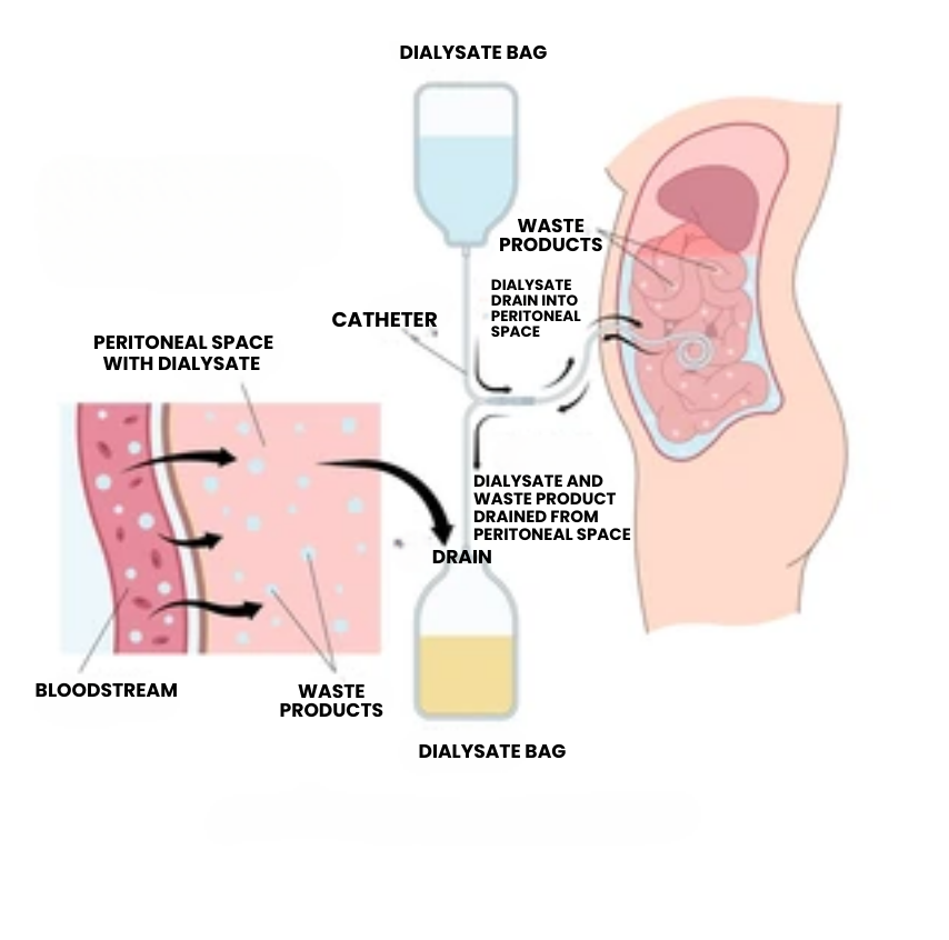 PERITONEAL DIALYSIS IN LUDHIANA